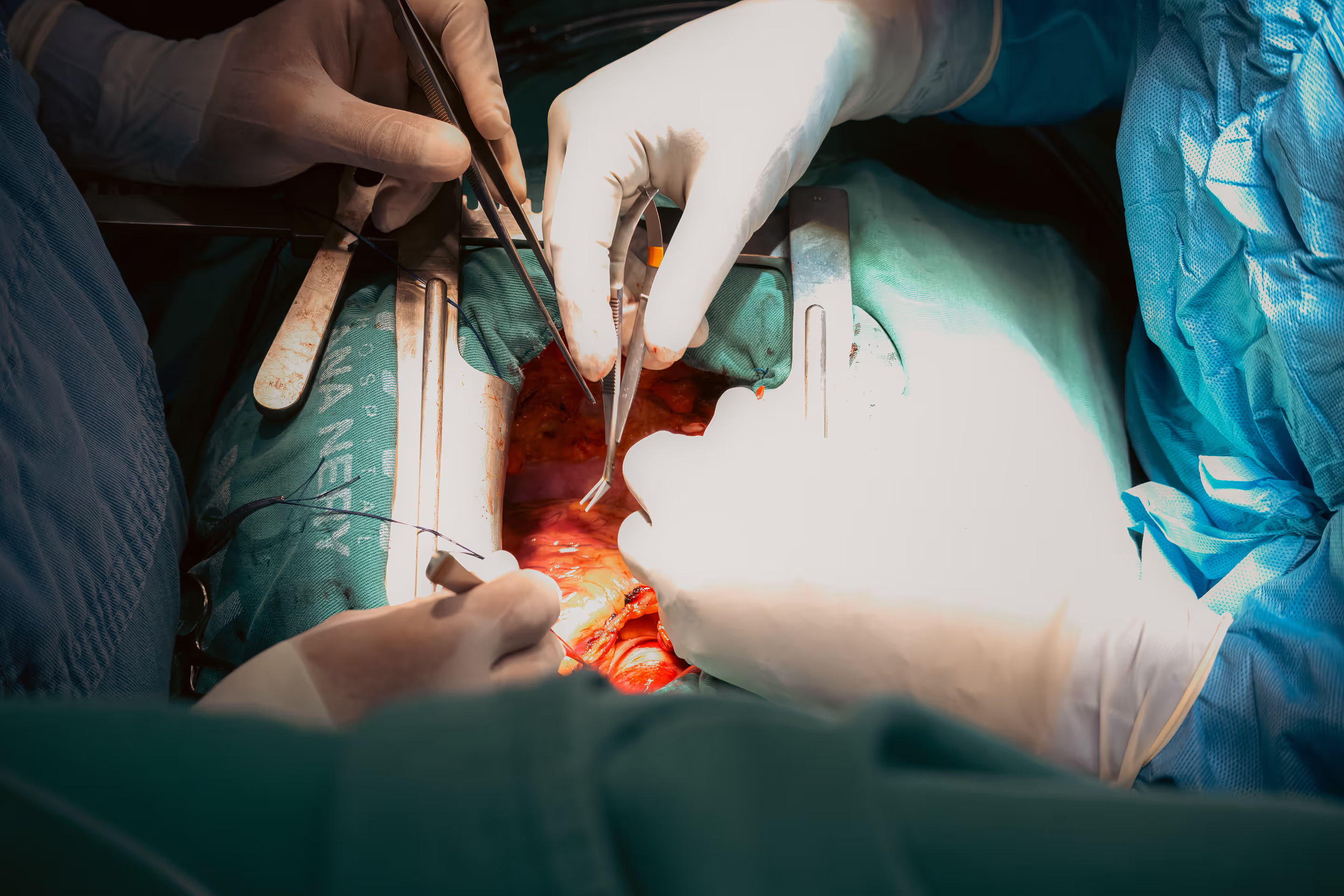 Imagem de uma cirurgia cardíaca em andamento. Três mãos com luvas cirúrgicas manuseiam pinças e outros instrumentos dentro do tórax aberto de um paciente, exposto e mantido aberto por afastadores metálicos. O campo operatório está coberto com panos cirúrgicos verdes e azuis, e a área central mostra tecidos e estruturas internas com sinais de sangramento controlado. A iluminação é intensa sobre o centro da operação, destacando o trabalho minucioso da equipe médica.